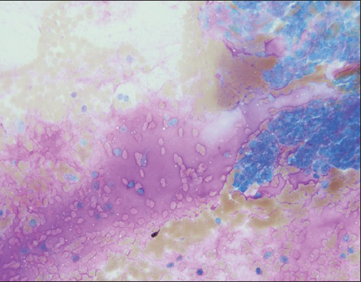 Abundant magenta colored mucoid material is present in the background (Diff quik stain, ×20)