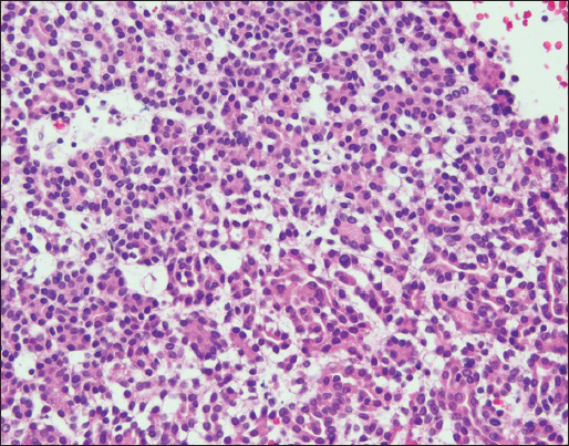 Cell block shows back to back eosinophilic cells with acinar/tubular architecture. No mitosis, atypia, or necrosis seen (H and E stain, ×20)