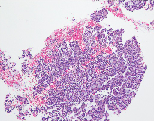 Core biopsy: Findings similar to cell block- blue mucinous/mucoid material is seen within acinar/tubular structures (H and E stain, ×10)