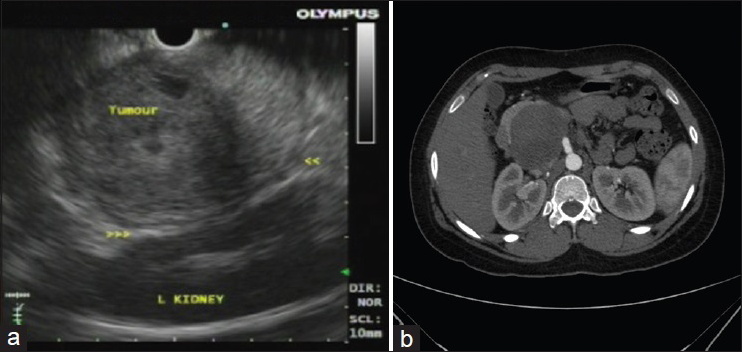 (a) Endoscopic ultrasound image showing a circumscribed neoplasm in the tail of the pancreas with heterogenous appearance in close relation to the spleen. (b) Computed tomography image showing a circumscribed pancreatic head mass