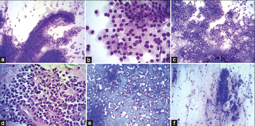 (a) Romanowsky stain showing tumor cells arranged in pseudopapillae and solid nests. Individual cells have round to oval nuclei with abundant eosinophilic cytopalasm ×200. (b) ×400 view of tumor cells showing evenly dispersed nuclear chromatin, regular nuclear membrane, and inconspicuous nucleoli. Cells are monomorphic with abundant cytoplasm. Cytoplasmic vacuoles present in few cells. (c) Solid sheets of tumor cells, cohesive as well as discohesive pattern ×200. (d) Myxoid fibrillary material forms the central core of these papillae. Nuclear membrane irregular in this case but with fine chromatin ×400. (e) Pancreatic neuroendocrine tumor: Cohesive and discohesive cellular smear. plasmacytoid appearance of tumor cells with eccentrically placed nucleus and nuclei with salt and pepper-like chromatin. (f) Intraductal papillary mucinous neoplasm: Columnar cells, cohesive clusters, bland nuclei with mucinous cytoplasm. Mucin in background