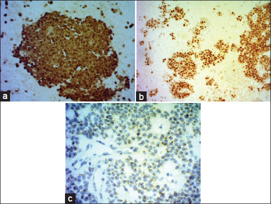 (a) β-catenin on cell block (nuclear and cytoplasmic positivity). (b) NSE on cell block. (c) CD 99 perinuclear dot like positivity