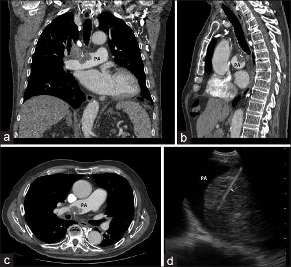 (a) Coronal, (b) sagittal, and (c), axial images of chest computed tomography demonstrating a mass (arrow) invading the right pulmonary artery (PA). (d) Image obtained during endobronchial ultrasound-guided transbronchial needle aspiration showing the sampling needle inside the intra-arterial mass (arrow) within the lumen of the pulmonary artery