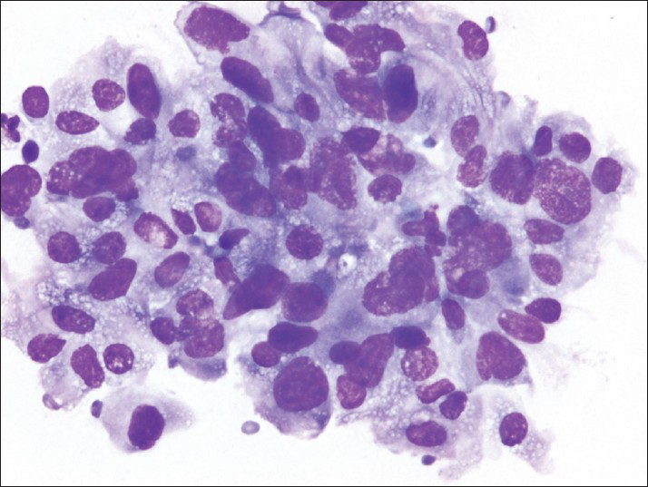 The air-dried smears show pleomorphic cells; many have large, irregular nuclei and finely vacuolated cytoplasm (Diff-Quik)