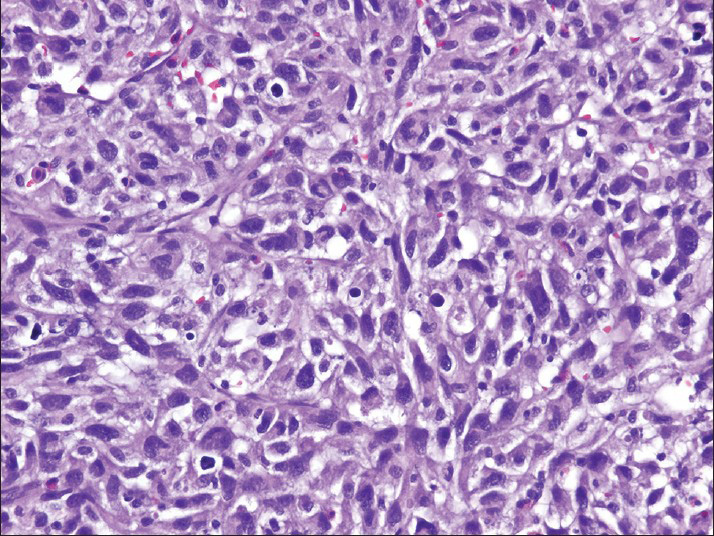 The cell block preparation contains pleomorphic cells with spindled and epithelioid features (H and E)