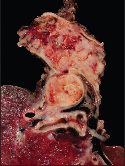 The gross resection shows the lumen of the pulmonary artery completely occulted by tumor