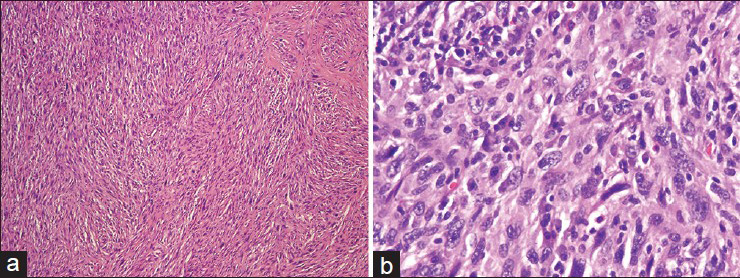 (a) The resected tumor demonstrates spindled cells with a storiform pattern (H and E). (b). Higher magnification shows pleomorphic cells with convoluted to spindled nuclei, often containing nucleoli (H and E)