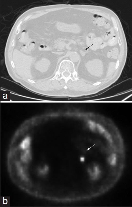 Images of computed tomography (a) and corresponding positron emission tomography (b) scan of the patient's abdomen showing the adrenal mass (arrow), 1.5 cm in diameter and standardized uptake value of 9.8