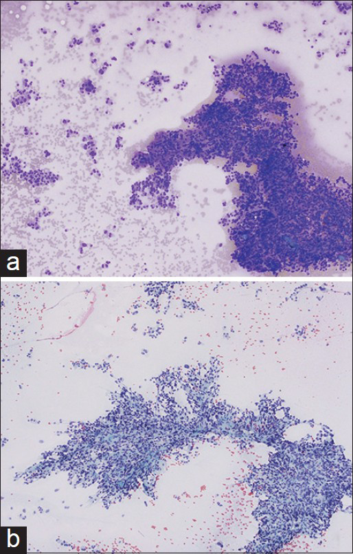 Low magnification of fine-needle aspiration smears, showing loosely cohesive sheets and single cells of oncocytic pheochromocytoma with Diff-Quik (a) and Papanicolaou (b) stains, (×100)