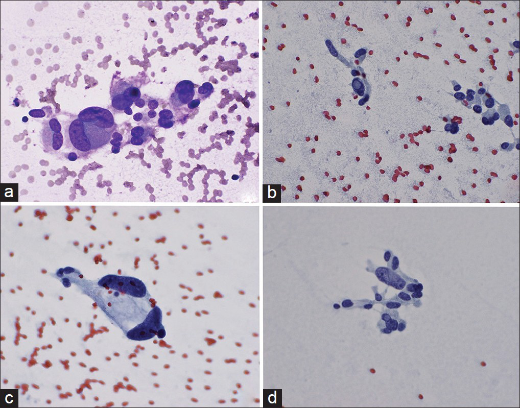 High magnification of tumor cells showing markedly pleomorphic and bizarre nuclei. (a) and (c) show binucleation and (b) and (d) show intranuclear pseudoinclusions, (×600)