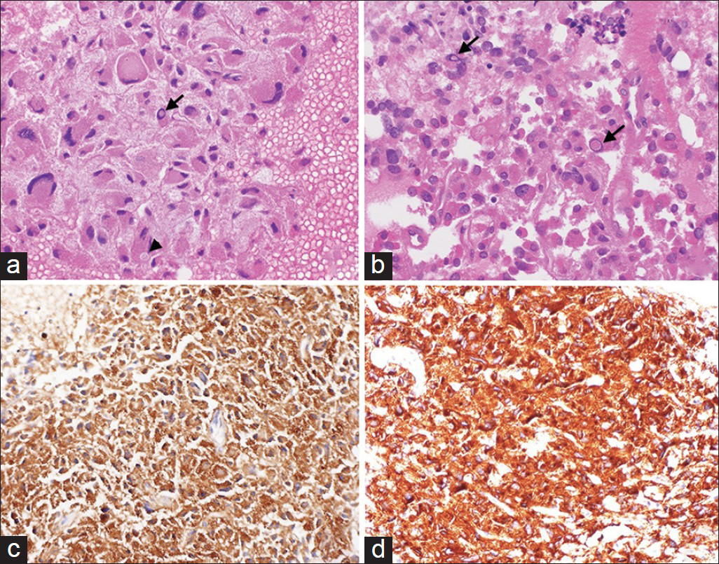 (a and b) Cell block preparation of the aspirate stained with H and E showing oncocytic tumor cells with abundant eosinophilic granular cytoplasm, nuclear pleomorphism, cytoplasmic inclusions (arrowhead), and intranuclear pseudoinclusions (arrows). Tumor cells show strong positivity to chromogranin (c) and synaptophysin (d), (×400)