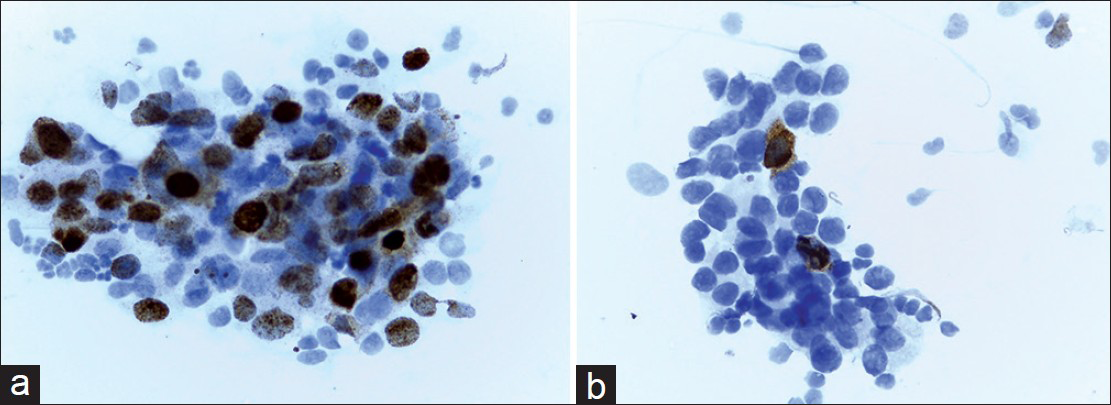 (a) Positive staining of pAkt in a high-grade breast tumor. About 40% of tumor cells demonstrate an obvious positive nuclear staining. In this case, cytoplasmic staining was noted as negative (×400). (b) Negative expression of pAkt in a breast tumor. Positive staining is limited to sporadic cells. Note coexistence of nuclear and cytoplasmic expression (×400)