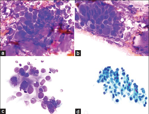 (a) Group of cohesive and pleomorphic tumor cells associated with a small amount of metachromatic fibromyxoid stroma with a vague fibrillary quality. This was a focal finding (Diff-Quik [DQ] stain, ×100). (b) A cluster of cohesive and three-dimensional pleomorphic tumor cells showing small fragments of homogeneous metachromatic fibromyxoid stroma in the background. The nuclei are enlarged, hyperchromatic and angulated. Nucleoli are not evident (DQ stain, ×100). (c) Loosely-cohesive cluster of tumor cells with large, somewhat irregular nuclei with occasional nucleoli (top of the group). Cytoplasm is scant-moderate and ill-defined with a finely granular texture (DQ stain, ×100). (d) Adenocarcinoma cells on a ThinPrep (TP) display coarse irregularly clumped chromatin, occasional nucleoli and dense to granular cytoplasm (TP, Pap stain, ×100)