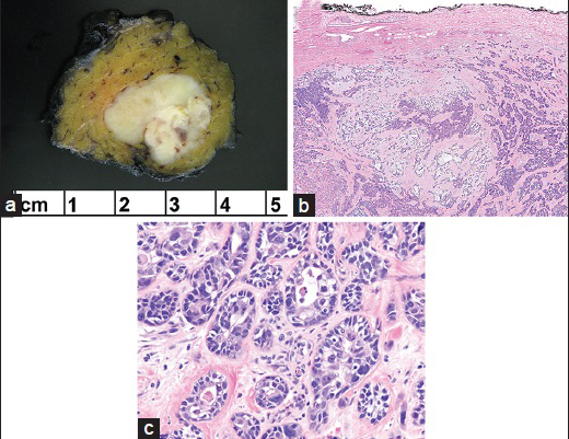 (a) The resection specimen showed a well-demarcated tumor with a yellow-white cut-surface and minute areas of hemorrhage. (b) Low magnification of carcinoma ex pleomorphic adenoma (PA) admixed with PA. Note the uninvolved intact capsule of PA (H and E, ×4). (c) High magnification reveals highly atypical ductal structures and single cells with cellular anaplasia, exhibiting pleomorphic nuclei and eosinophilic cytoplasm (H and E, ×40)