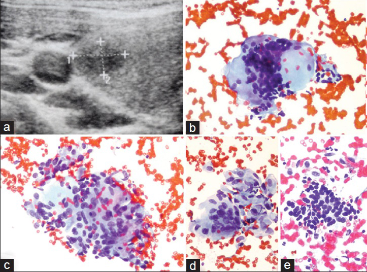 A Subacute granulomatous thyroiditis case sonographically characterized by an ill-defined hypoechoic nodule (case no. 17). (a) An ultrasound image showing a ill-defined nodule. The cytologic features of the case included the following: (b) Multi-nucleated giant cell (Papanicolau stain, ×400), (c) an epithelioid histiocytic granuloma (Papanicolau stain, ×400), (d) a group of epithelioid histiocytes adjacent to a giant cell (Papanicolau stain, ×400) and (e) a collection of proliferated follicular cells (Papanicolau stain, ×200)