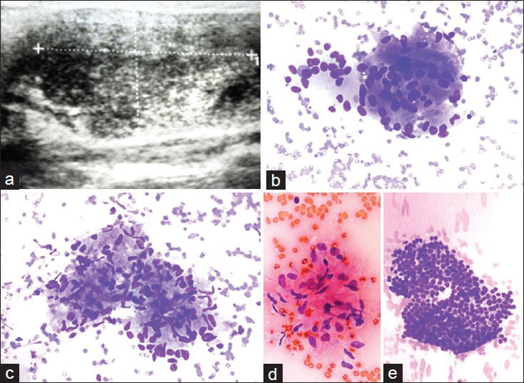 A subacute granulomatous thyroiditis case with a sonographic image of a poorly defined hypoechoic area. (a) Ultrasound appearance with a discrete area (case no. 19). The cytologic features of the case included the following: (b) Multinucleated giant cell (Diff Quik®, ×400), (c) an aggregate of epitheliod histiocytes consistent with granuloma (Diff Quik®, ×400), (d) a cluster of epithelioid histiocytes (Papanicolau stain × 400) and (e) a group of proliferated follicular cells (Diff Quik®, ×400)