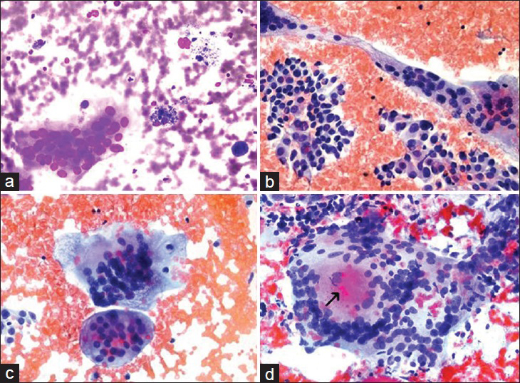 The types of multinucleated giants cells seen in various thyroid lesions. (a) Multinucleated giant cell secondary to a benign cystic nodule (our archival case) (Diff Quik®, ×400). (b) Bizarre giant cells seen in a case papillary thyroid carcinoma (our archival case) (Papanicolau stain, ×400). (c) Multinucleated giant cells encountered in the previous papillary thyroid carcinoma case (×400). (d) Multinucleated giant cell with an intracytoplasmic colloid like material (arrow) seen in one of our subacute granulomatous thyroiditis cases (case no. 21) (Papanicolau stain, ×400)