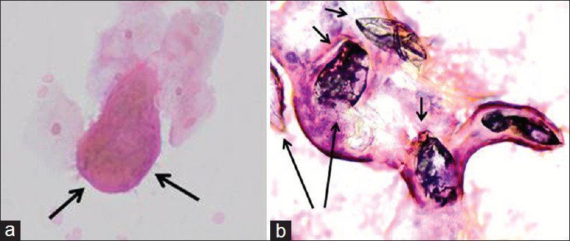 (a) Cervical smear, magnification (Papanicolaou stain, ×40). Arrows: emergent miracidium with a finely ciliated outline. (b) Cervical smear, magnification (Papanicolaou stain, ×40). Numerous calcified, dead ova (four calcified ova - short arrows and two non-calcified ova - long arrows) of Schistosoma haematobium