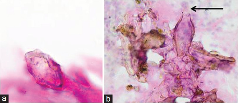 (a) Cervical smear, magnification (Papanicolaou stain, ×40). A contaminant easily misdiagnosed for Schistosoma haematobium ova. Note the lack of a diagnostic terminal spine. (b) Cervical smear, magnification (Papanicolaou stain, ×40). Arrow: Schistosoma ovum with a terminal spine found among contaminants