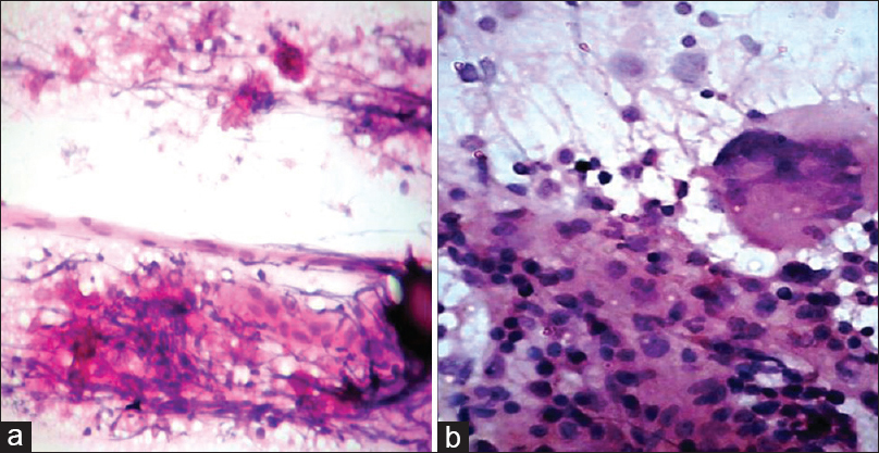 (a) Scrape smear showing sheets of epithelioid cells along with fibrous connective tissue elements (H and E, ×100). (b) Scrape smear in tuberculous infection with epithelioid cells and foreign body giant cell (H and E, ×400)