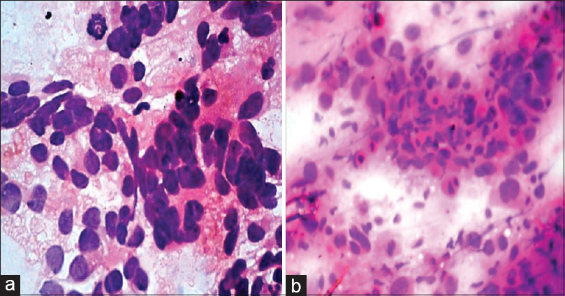 (a) Scrape smear showing adenocarcinomatous cells in gland patterns with pleomorphic nuclei and also with high mitotic activity (H and E, ×400). (b) Scrape smear of a squamous cell carcinoma metastases with malignant epithelial cells having moderate amount of bright eosinophilic cytoplasm and pyknotic nuclei (H and E, ×400)