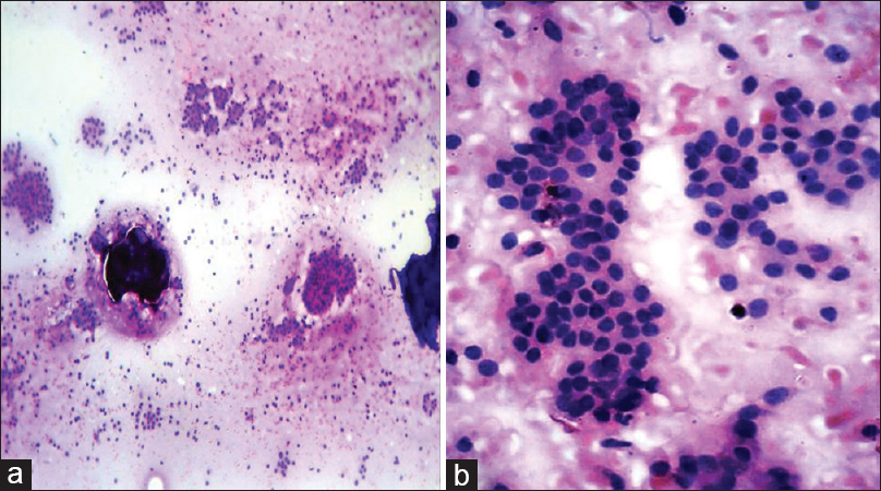 (a) Scrape smear of metastases from a follicular carcinoma of thyroid showing small cells in follicular patterns (H and E, ×100). (b) Scrape smear higher magnification of the metastases from a follicular carcinoma of thyroid (H and E, ×400)