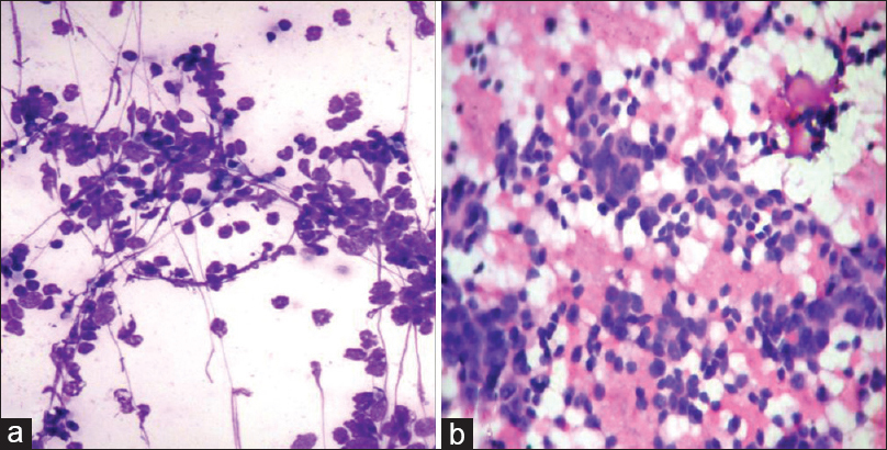 (a) Scrape smear of a non-Hodgkins Lymphoma with round to oval cells having minimum cytoplasm and smear artifact (H and E, ×400). (b) Scrape smear of Ewing's sarcoma with round cells in vague rosette patterns against a hemorrhagic background (H and E, ×400)