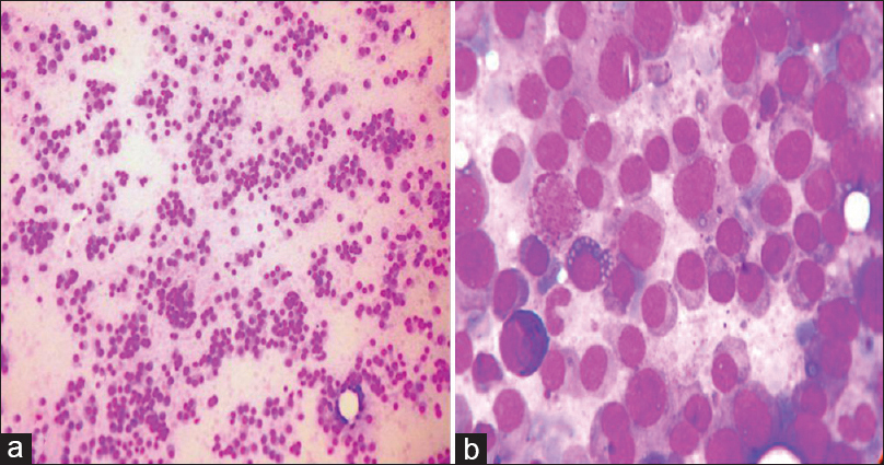 (a) Scrape smear of myeloma showing high cellularity and composed of cells with eccentric nuclei and moderate amount of cytoplasm (H and E, ×100). (b) Scrape smear of myeloma with plasma cells, plasmablasts and Mott cells (H and E, ×400)