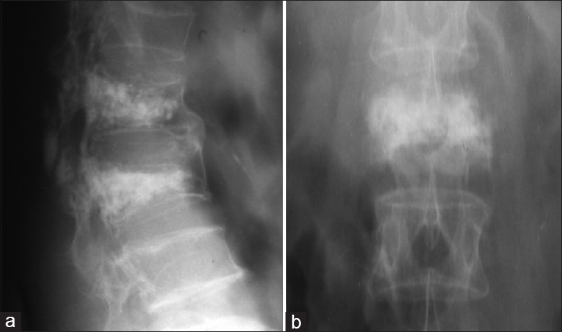 (a and b) Postoperative images after vertebroplasty was done in a case of vertebral metastases