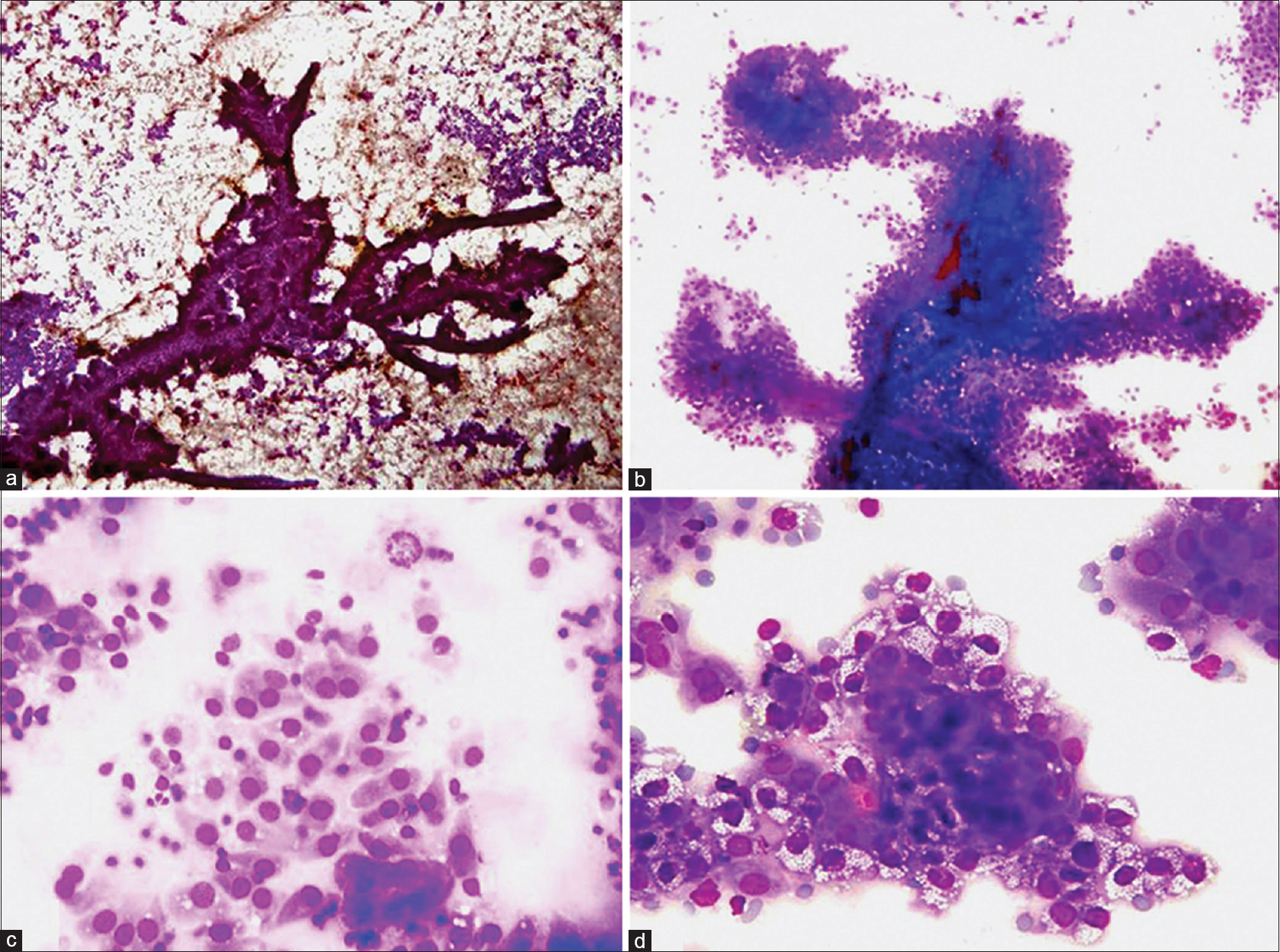 (a and b) Complex papillary pattern along with singly scattered cells (a: Papanicolaou, ×40). Fibrovascular cores are also visible (b: May-Grunwald-Giemsa, ×100). (c) Dispersed cells displaying cuboidal to columnar cells with eccentrically placed nuclei exhibiting mild pleomorphism. An occasional mitotic figure is also seen at the top of the field (May-Grunwald-Giemsa, ×400). (d) Cells showing vacuolated cytoplasm with soap bubble appearance (May-Grunwald-Giemsa, ×400)