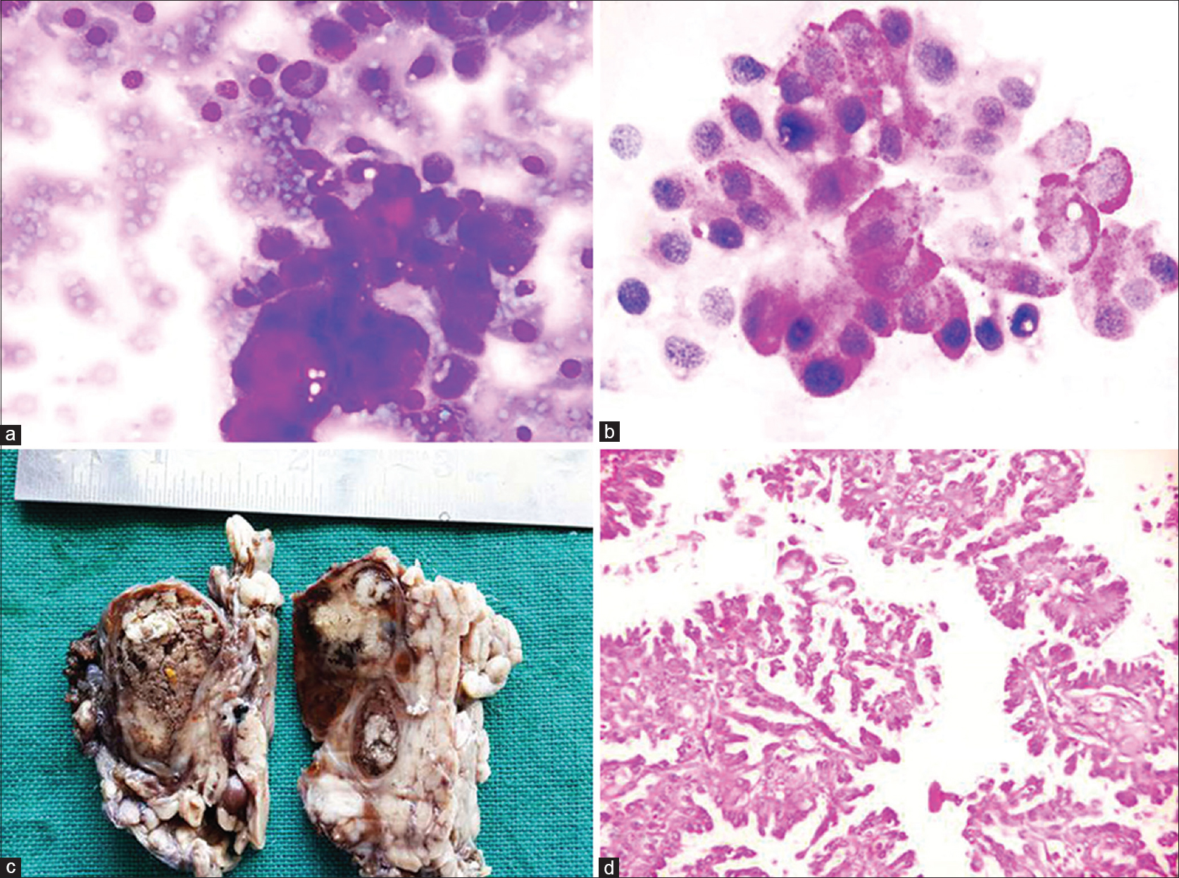 (a) Some cells show eccentric nuclei with bright eosinophilic mucin vacuole (May-Grunwald-Giemsa, ×400). (b) Vacuolated cells showing periodic acid–Schiff with acid digestion positivity (PAS-AD, ×400). (c) A partially cystic and partially solid mass with friable papillary projections. (d) Sections showing cuboidal to columnar cells with mild cellular atypia displaying pseudostratification (H and E, ×100)