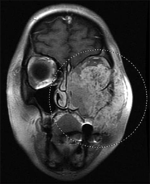 Coronal plane magnetic resonance imaging of the face shows a large tumor that fills the left maxillary sinus and invades the nasal cavity, face, and orbit, displacing the left globe