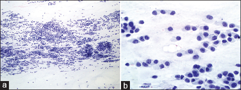 Fine needle aspiration smears of the maxillary sinus mass showing (a) cellular specimen consists of numerous cells arranging singly and in small clusters (Papanicolaou, ×10). (b) The malignant cells are round-to-oval and exhibit eccentrically located nuclei with fine chromatin and nucleoli (Papanicolaou, ×40)