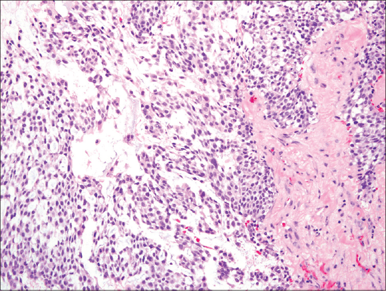 Tissue biopsy of the maxillary sinus mass showing sheets of plasmacytoid malignant cells with thick fibrous intervening myxoid stroma (H and E, ×20)
