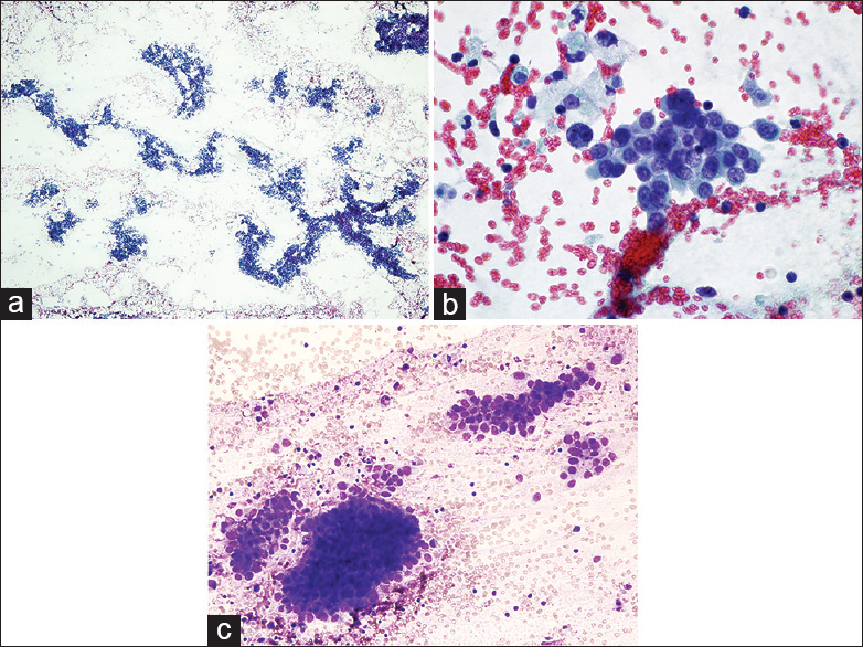 Pleural fluid smears showing (a) numerous malignant cells arranging singly and in small aggregates (Papanicolaou, ×4). (b) The malignant cells exhibit eccentrically located nuclei with fine chromatin and nucleoli (Papanicolaou, ×40) and (c) (Diff-Quick, ×20)