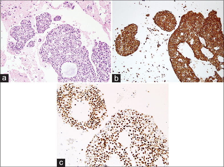 Cell block tissue section showing (a) clusters of malignant cells (H and E, ×20), (b) positive for p63, and (c) pancytokeratin (AE1/AE3)