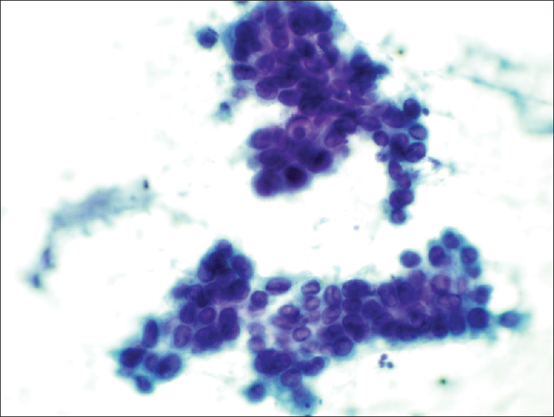 The Papanicolaou stain cytology smear slide shows that the epithelioid cells were relatively uniform. The cells had a high nuclear-to-cytoplasmic ratio. The nuclei were predominantly oval and exhibited fine nuclear chromatin. Quite prominent nuclear grooves and irregular nuclear membrane were also noted (×400)