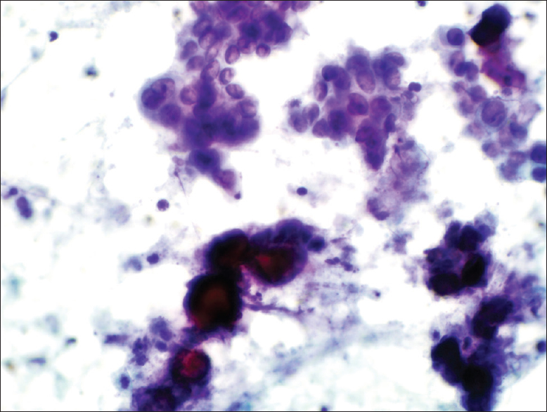 The Papanicolaou stain cytology smear slide shows several psammoma bodies associated with tumor cells (×400)