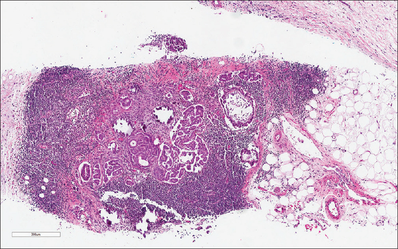 The needle core biopsy shows deposits of tubular and papillary groups of tumor cells with psammomatous calcification in the background of lymphoid tissue (H and E, ×200)