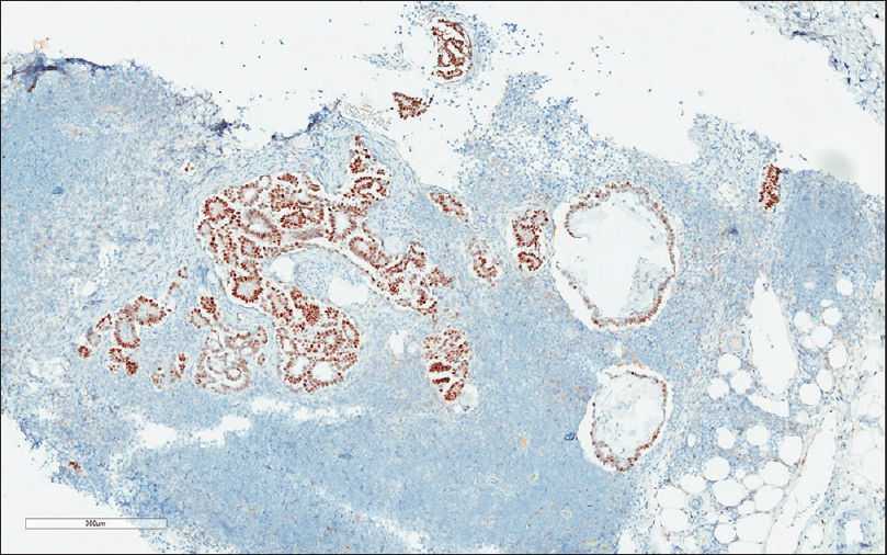 The tumor cells are immunoreactive with estrogen receptor (×200)