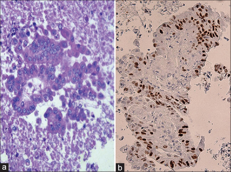 Cell block procedure sample - pseudoglandular pattern of neoplastic elements from metastatic colonic carcinoma presenting as a pancreatic mass (H and E, ×40) (a). In parallel section, immunohistochemistry revealed a strong nuclear reactivity for CDX2 (Mayer's hemalum counterstain, ×40) (b)