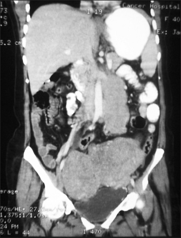 Computed tomography of abdomen showing bilateral large adnexal masses with bilateral hydronephrosis due to compression of ureters