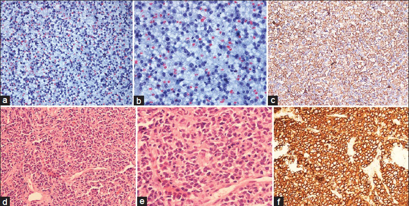 (a) Dyscohesive tumor cells, Pap, ×200; (b) the tumor cells have large round pleomorphic nuclei and conspicuous nucleoli. Lymphoglandular bodies are also seen in the background, Pap, ×400; (c) tumor cells show immunopositivity for CD20 × 200; (d) tumor cells dispersed singly, H and E, ×100; (e) the tumor cells are large, pleomorphic and show mitoses, H and E; (f) strong immunopositivity for CD20 is seen in the tumor cells, ×200