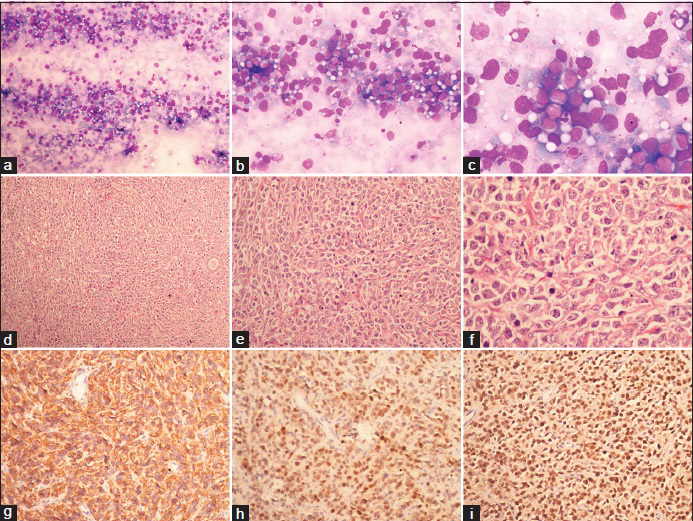 (a) Predominantly dispersed tumor cells; MGG, ×100; (b) high nucleocytoplasmic ratio and moderate pleomorphism; MGG × 200; (c) minimal vacoulated cytoplasm, opened up nuclear chromatin and small nucleoli at places; MGG × 400; (d) tumor cells arranged in solid sheet and focally in cords; H and E, ×100; (e) minimal cytoplasm, pleomorphic nuclei and frequent apoptoses; H and E, ×200; (f) small nucleoli. Macrophages with engulfed debris are also seen; H and E, ×400; (g) tumor cells are immunopositive for CD20 (h) BCL6; (i) MIB1 labeling index of 98% ×200