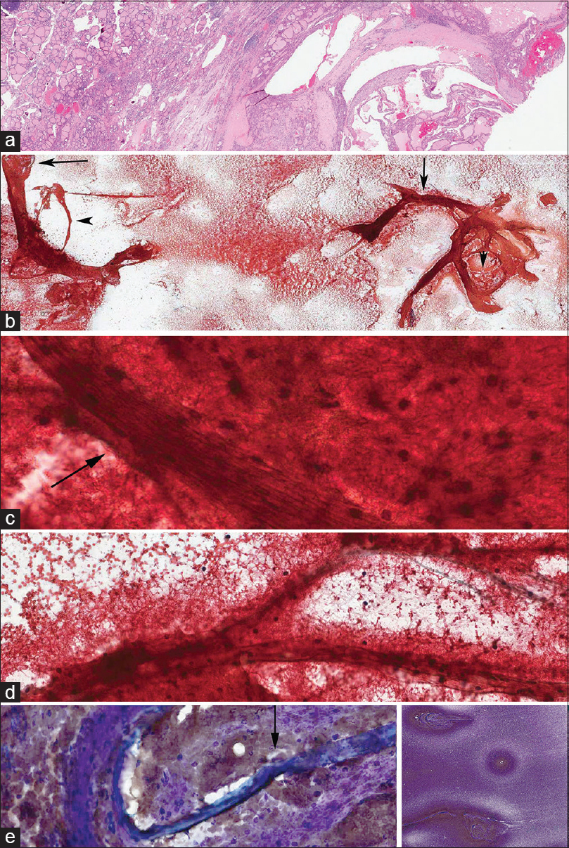 Multinodular goiter with fine-needle aspiration biopsy predominantly consisting of Type 1a stroma and focally Type 1b. (a) Multinodular goiter. (b) Predominantly Type 1a stroma showing thick, long, and curved or circular bands with entrapped blood (arrow). Note the clearing background of blood around the stromal fragments. (c and d) High magnification views of Type 1a stroma entrapped with red blood cells, fibrin with focal areas of Type 1b stroma (arrow). (c) Predominantly Type 1a stroma with mesh-like architecture and with a bundle of parallel fibers forming Type 1b stroma (arrow). Scattered fibroblasts were seen in Type 1b stroma. (d) Semi-translucent bands of Type 1b. (e) MGG stain showing the background of Type 1a stroma, fragments of Type 1b with (arrow) and without hyalinization. Note the entrapped blood clots, readily identified fibroblasts in the nonhyalinized stroma. Inset: Low magnification view of the smear showing dark-stained areas with stromal fragments with a clear halo due to decreased number of red blood cells (For improved resolution with enlargement of all images, please refer to the digital / online version of the article.)