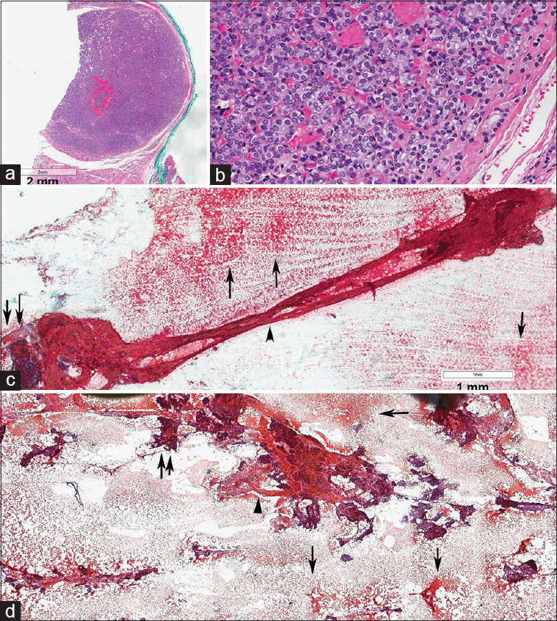 (a and b) Encapsulated papillary thyroid carcinoma measuring 6 mm in diamter. (c and d) fine-needle aspiration biopsy showing Type 2 stroma (arrows) and fragment of Type 1b stroma with a flat and twisted ring of stroma in the shape of an “8” (arrowhead), likely from the capsule of the neoplasm. Note the entrapping and coating with blood clot and numerous microfollicles (double arrows) (For improved resolution with enlargement of all images, please refer to the digital / online version of the article.)