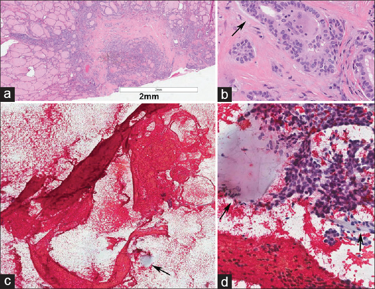 (a and b) Microscopic sclerosing papillary thyroid carcinoma with desmoplasia of the stroma measuring 3mm in diameter, note the stroma showed focal mucoid change (arrow). (c) Type 1 stroma with ring shape and radiating strands consistent with the stroma of the microcarcinoma. Note the size and the stroma structure stretched in the smear measured 6 mm, twice the diameter of the tumor (postfixed in formalin). (d) Clusters of papillary thyroid carcinoma cells. Note the mucoid material indicated by arrow in c and d (For improved resolution with enlargement of all images, please refer to the digital / online version of the article.)