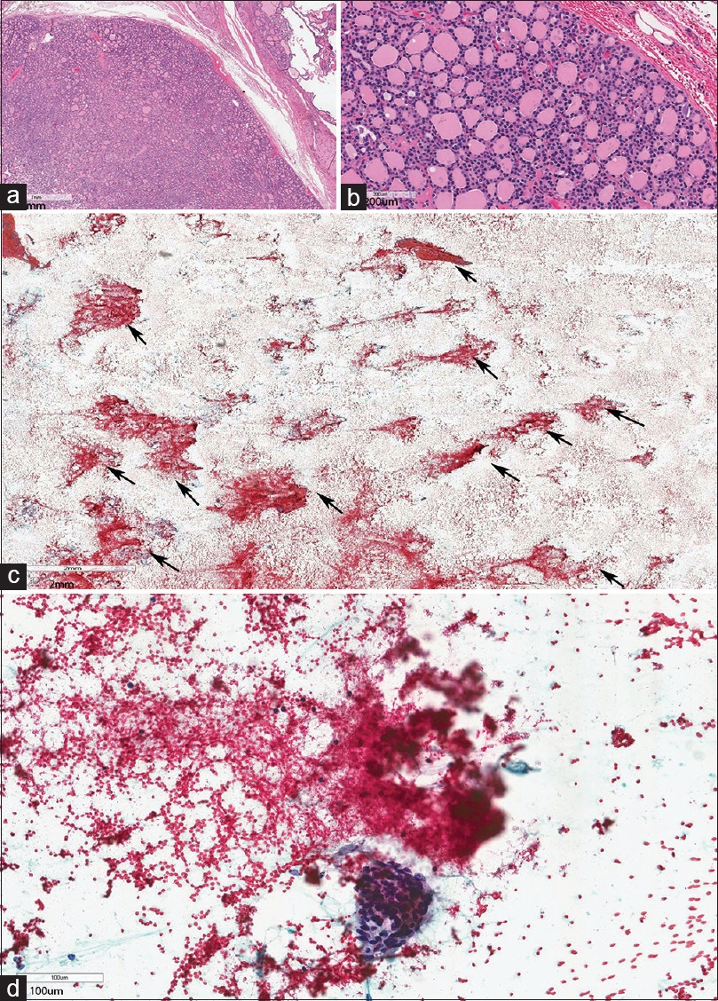 (a and b) Follicular adenoma. (c and d) fine-needle aspiration biopsy predominantly consisting of Type 2 stroma with entrapped blood cells in multiple clusters (arrows). Type 1 stroma was scant (For improved resolution with enlargement of all images, please refer to the digital / online version of the article.)