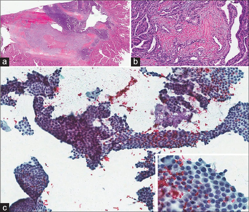 (a and b) Papillary thyroid carcinoma with desmoplasia of the stroma. (c) Fine-needle aspiration biopsy showing almost only clusters of papillary thyroid carcinoma cells. Inset: High magnification showing nuclear changes of papillary thyroid carcinoma (For improved resolution with enlargement of all images, please refer to the digital / online version of the article.)