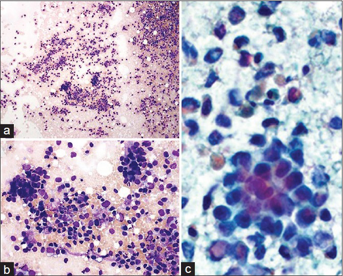 Cytological preparations; Diff-Quik (a and b) and Papanicolaou (c) stained fine needle aspiration smears. (a) Hypercellular specimen; loosely dispersed malignant cells and occasional tumor clusters (×200). (b) Single and clustered tumor cells with marked anisonucleosis and poorly defined cell borders (×400). (c) Prominent cell dissociation and background necrosis. Hyperchromatic nuclei with irregular borders, coarse chromatin, and scant cytoplasm (×400, digitally magnified). (For improved resolution with enlargement of all images, please refer to the digital/online version of the article)